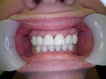 AFTER photo (this procedure consists of Crowns & Veneers)